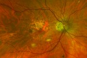 DEGERACIÓN MACULAR RELACIONADA CON LA EDAD (DMRE)