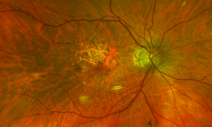DEGERACIÓN MACULAR RELACIONADA CON LA EDAD (DMRE)