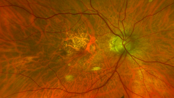 DEGERACIÓN MACULAR RELACIONADA CON LA EDAD (DMRE)